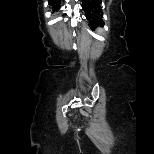 Closed loop small bowel obstruction due to adhesive band, with intramural hemorrhage and ischemia (Radiopaedia 83831-99017 C 109).jpg