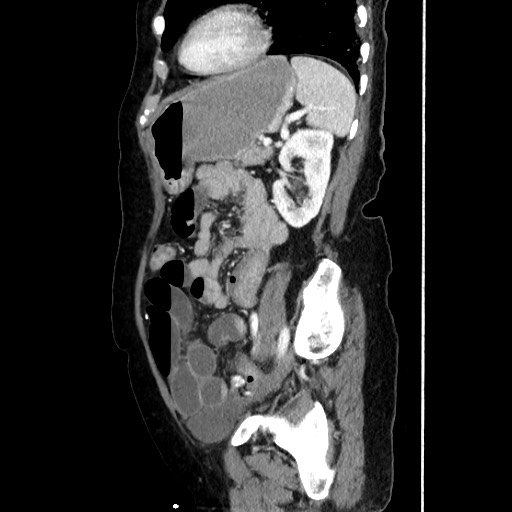 Closed loop small bowel obstruction due to adhesive band, with intramural hemorrhage and ischemia (Radiopaedia 83831-99017 D 134).jpg