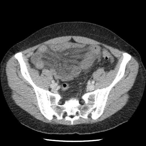 Closed loop small bowel obstruction due to trans-omental herniation (Radiopaedia 35593-37109 A 66).jpg