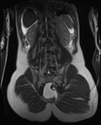 File:Closed loop small bowel obstruction in pregnancy (MRI) (Radiopaedia 87637-104031 Coronal T2 44).jpg