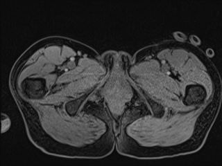 Closed loop small bowel obstruction in pregnancy (MRI) (Radiopaedia 87637-104031 G 38).jpg