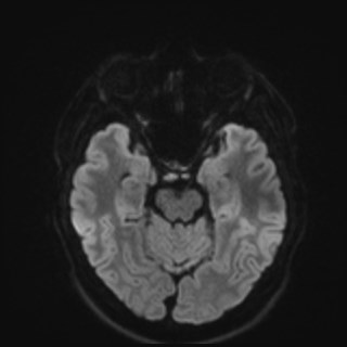 File:Cochlear incomplete partition type III associated with hypothalamic hamartoma (Radiopaedia 88756-105498 Axial DWI 55).jpg