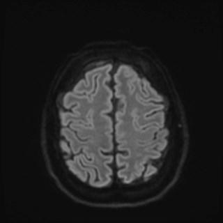 File:Cochlear incomplete partition type III associated with hypothalamic hamartoma (Radiopaedia 88756-105498 Axial DWI 73).jpg