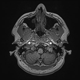 Cochlear incomplete partition type III associated with hypothalamic hamartoma (Radiopaedia 88756-105498 Axial T1 38).jpg