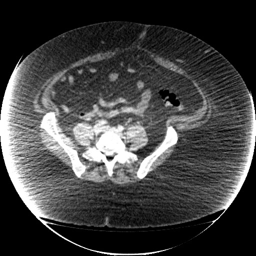 File:Collection due to leak after sleeve gastrectomy (Radiopaedia 55504-61972 A 57).jpg