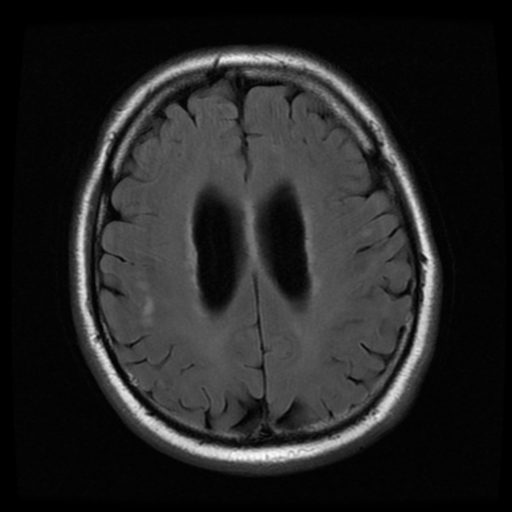 File:Colloid cyst (large) (Radiopaedia 34415-35729 Axial FLAIR 16).png