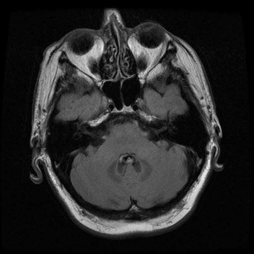File:Colloid cyst (large) (Radiopaedia 34415-35729 Axial FLAIR 6).png