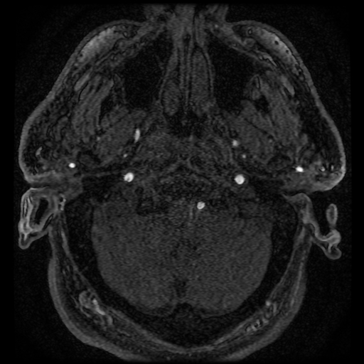 File:Colloid cyst with anterior communicating artery aneurysm (Radiopaedia 33901-35091 Axial MRA 51).jpg