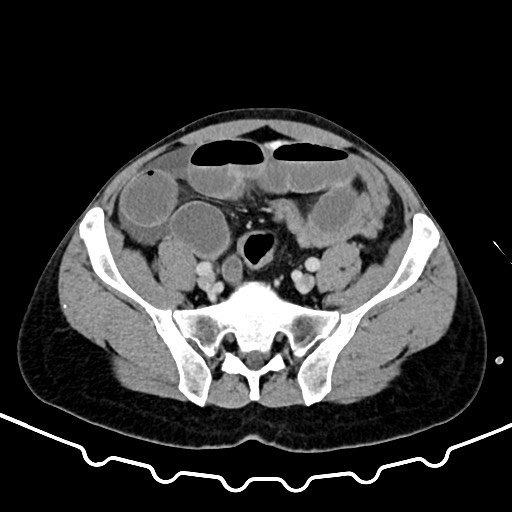 Colocolic intussusception due to large lipoma (Radiopaedia 68773-78482 A 144).jpg