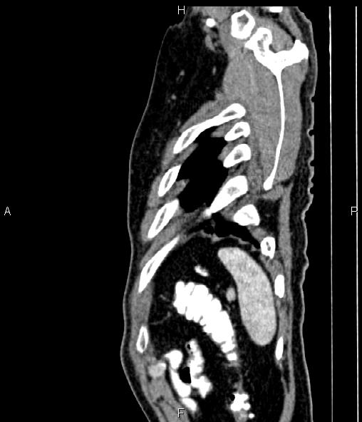Colon adenocarcinoma (Radiopaedia 83266-97671 D 97).jpg