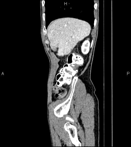 Colon adenocarcinoma - hepatic flexure (Radiopaedia 85635-101395 D 13).jpg