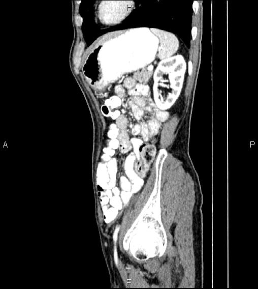Colon adenocarcinoma - hepatic flexure (Radiopaedia 85635-101395 D 69).jpg