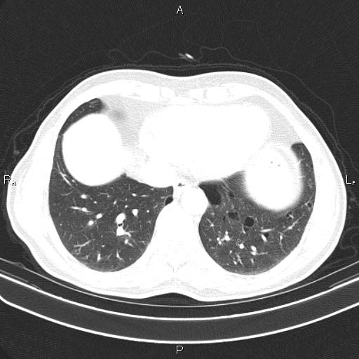 File:Colon cancer (Radiopaedia 85663-101443 Axial lung window 48).jpg