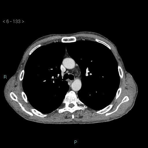 Colonic cancer (ultrasound and TC imaging) (Radiopaedia 50346-55713 B 133).jpg