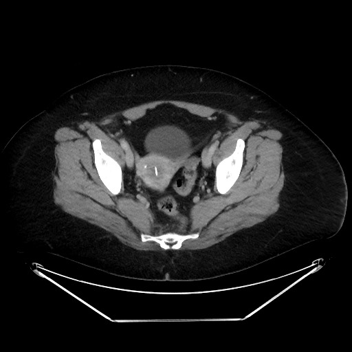 File:Colonic intussusception due to adenocarcinoma (Radiopaedia 86828-102987 A 128).jpg