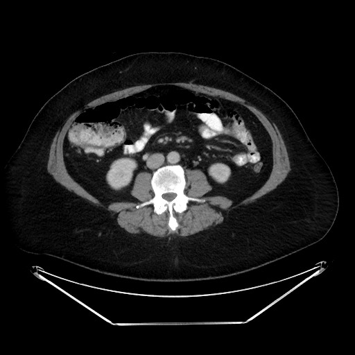 File:Colonic intussusception due to adenocarcinoma (Radiopaedia 86828-102987 Axial 13).jpg