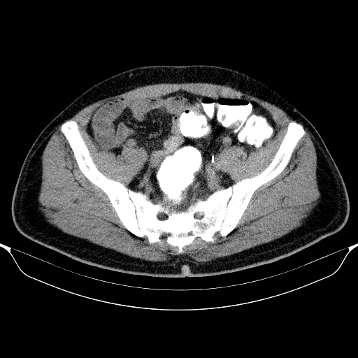 Colonic lipoma with colo-colic intussusception (Radiopaedia 58944-66200 Axial C+ rectal 56).jpg