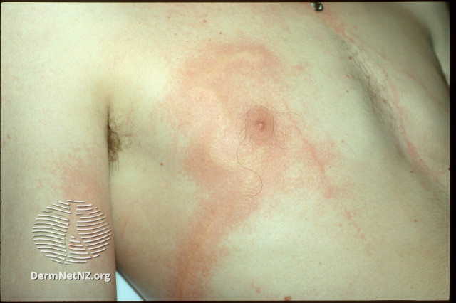 File:Early skin lesion (DermNet NZ chironex-fleckeri-02).jpg