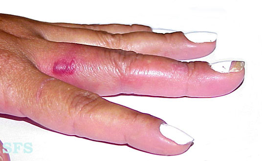 File:Erysipeloid (Dermatology Atlas 2).jpg