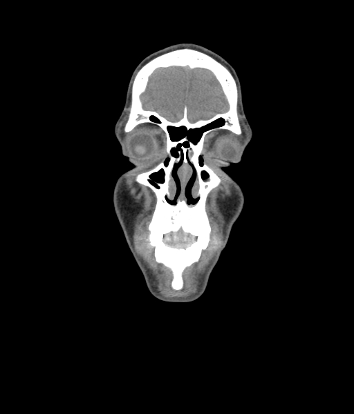 Nasal pyogenic granuloma (lobular capillary hemangioma) (Radiopaedia 85536-101244 Coronal non-contrast 57).jpg