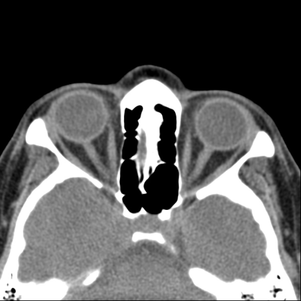 Nasolabial cyst (Radiopaedia 33987-35205 Axial non-contrast 36).jpg