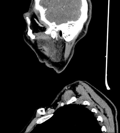 File:Nasopharyngeal carcinoma - infiltrating the clivus (Radiopaedia 62583-70875 C 46).jpg