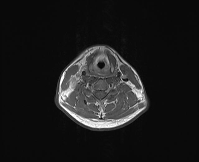 File:Nasopharyngeal carcinoma with perineural spread (Radiopaedia 55030-61380 Axial T1 11).jpg