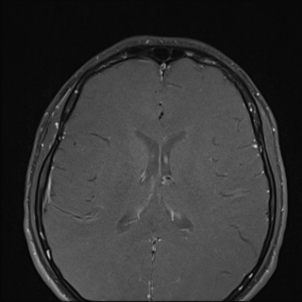 Nasopharyngeal carcinoma with skull base invasion (Radiopaedia 53415-59485 Axial T1 C+ fat sat 4).jpg