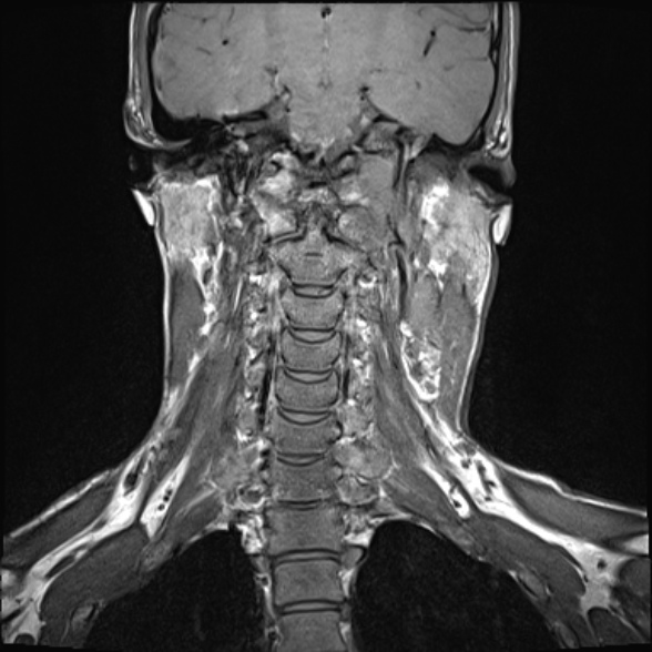 File:Nasopharyngeal carcinoma with skull base invasion (Radiopaedia 53415-59485 Coronal T1 13).jpg