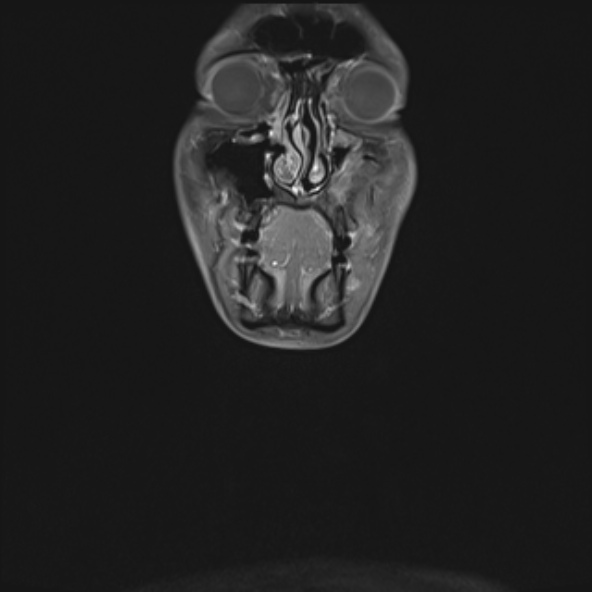 Nasopharyngeal carcinoma with skull base invasion (Radiopaedia 53415-59485 E 38).jpg