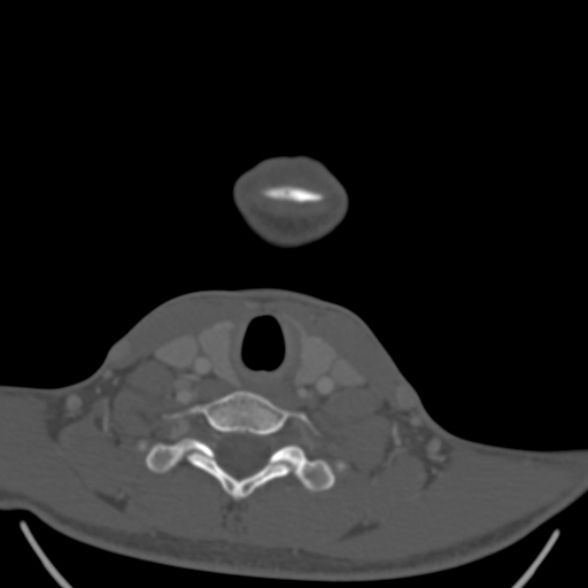 Nasopharyngeal carcinoma with skull base invasion (Radiopaedia 53415-59705 Axial bone window 168).jpg