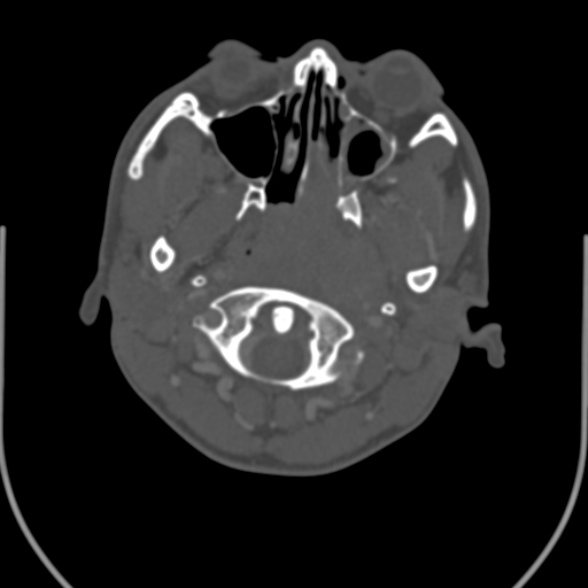 Nasopharyngeal carcinoma with skull base invasion (Radiopaedia 53415-59705 Axial bone window 41).jpg