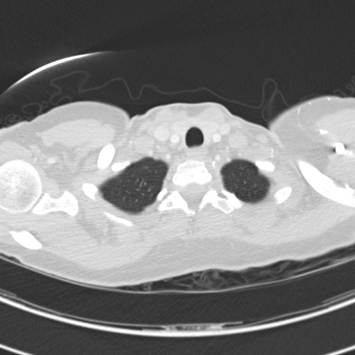 Necrobiotic pulmonary nodules - Crohn disease (Radiopaedia 20723-20631 Axial lung window 12).jpg