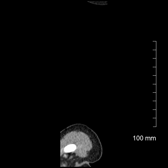 File:Neonatal neuroblastoma (Radiopaedia 56651-63438 C 2).jpg
