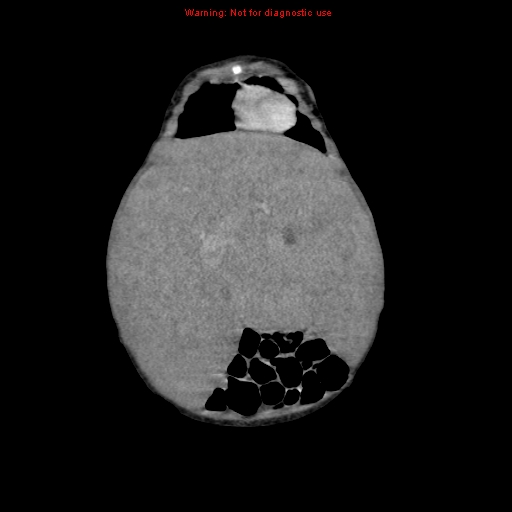 File:Neonatal neuroblastoma (Radiopaedia 9564-10223 B 32).jpg