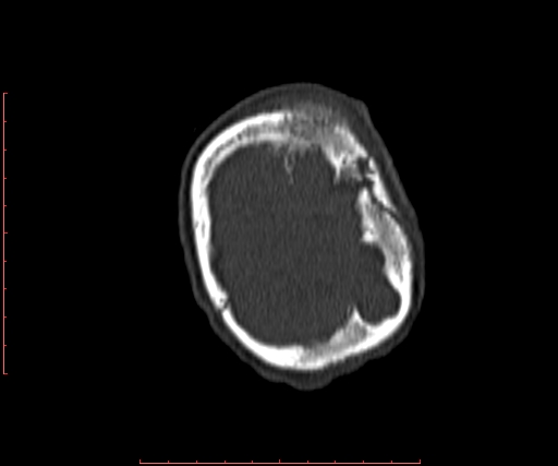 File:Neuroblastoma skull metastasis (Radiopaedia 56053-62683 Coronal bone window 41).jpg