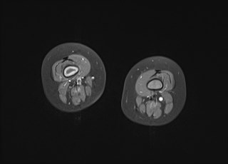 File:Neuroblastoma with bone metastases (Radiopaedia 67080-76414 Axial T1 C+ fat sat 17).jpg
