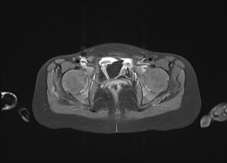 File:Neuroblastoma with bone metastases (Radiopaedia 67080-76414 Axial T1 C+ fat sat 48).jpg