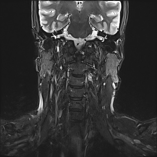 File:Neurofibromatosis type 1 (Radiopaedia 80355-93740 Coronal STIR 4).jpg