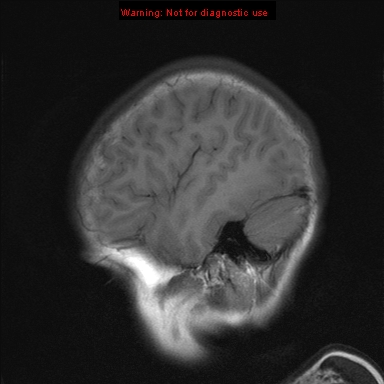 File:Neurofibromatosis type 1 with optic nerve glioma (Radiopaedia 16288-15965 Sagittal T1 20).jpg
