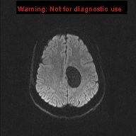 File:Neuroglial cyst (Radiopaedia 10713-11184 Axial DWI 30).jpg