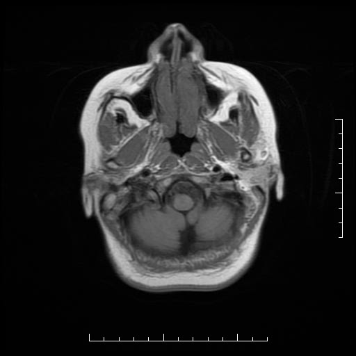 File:Neuroglial cyst of brainstem (Radiopaedia 29134-29526 Axial T1 2).jpg