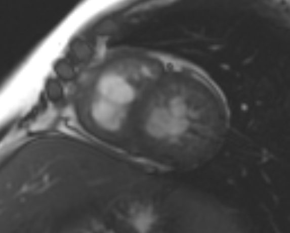 File:Non-compaction of the left ventricle (Radiopaedia 69436-79314 Short axis cine 108).jpg