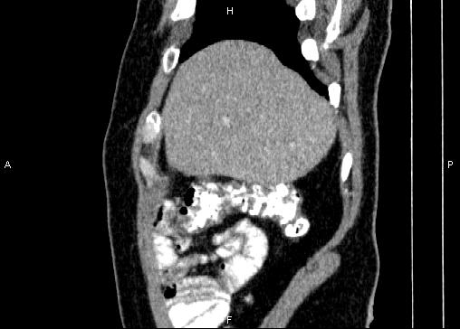 Non-syndromic pancreatic endocrine tumor (Radiopaedia 86958-103178 E 11).jpg
