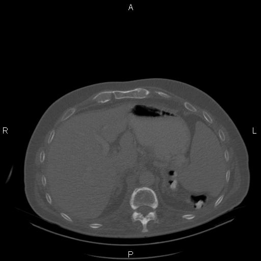 Non Hodgkin lymphoma in a patient with ankylosing spondylitis (Radiopaedia 84323-99624 Axial bone window 28).jpg