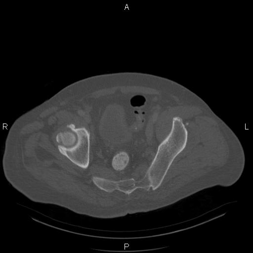 Non Hodgkin lymphoma in a patient with ankylosing spondylitis (Radiopaedia 84323-99624 Axial bone window 58).jpg