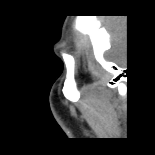 Normal CT paranasal sinuses (Radiopaedia 42286-45390 F 131).jpg