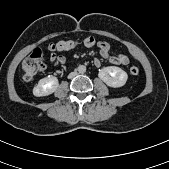 File:Normal CT split bolus study of the renal tract (Radiopaedia 48631-53634 Axial split bolus 135).jpg