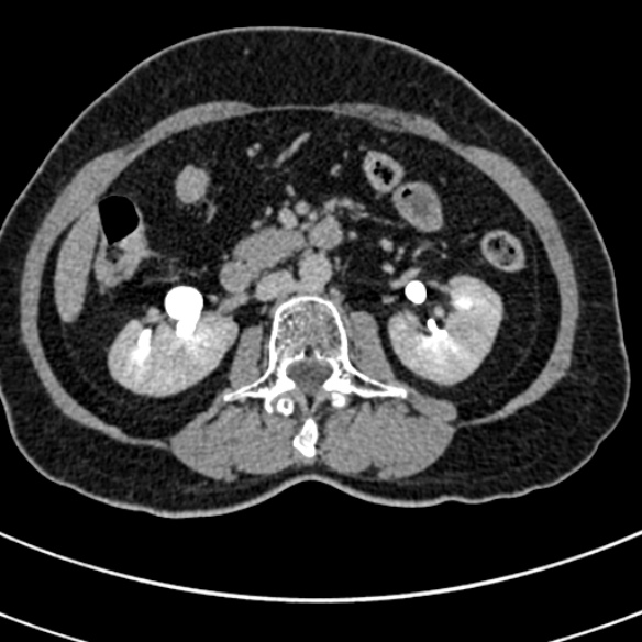 File:Normal CT split bolus study of the renal tract (Radiopaedia 48631-53634 Axial split bolus 91).jpg