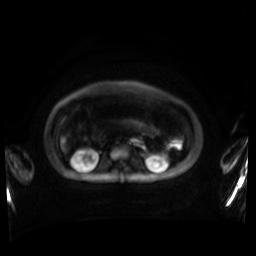 Normal MRI abdomen in pregnancy (Radiopaedia 88001-104541 Axial DWI 73).jpg